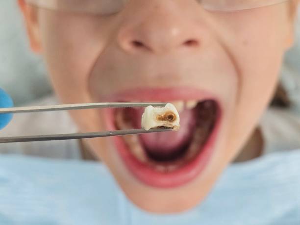 Best Emergency Root Canal Treatment in Baldwin, FL